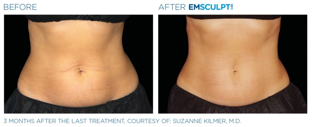 Before and after photo of EmSculpt NEO abdomen/stomach treatment for women in Franklin, TN.
