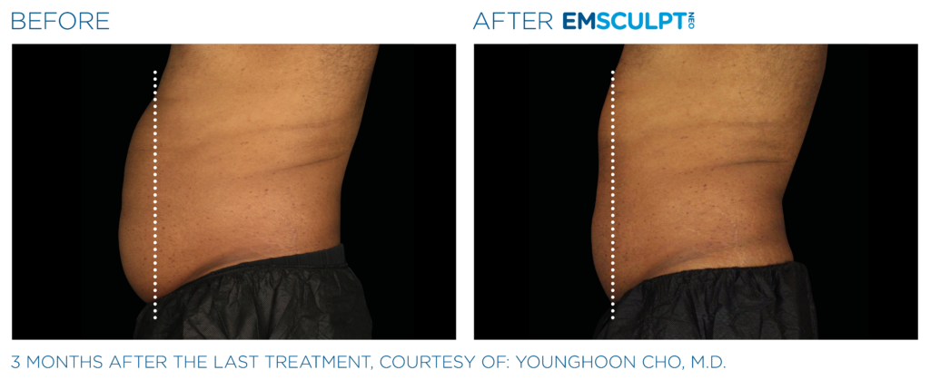 Before and after photos of EmSculpt NEO men's abdomen/stomach treatment in Franklin, TN.